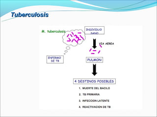 Tuberculosis
 