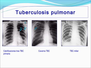 Tuberculosis pulmonar




Calcificaciones tras TBC   Caverna TBC   TBC miliar
primaria
 