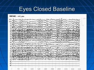 Eyes Closed BaselineEyes Closed Baseline
 