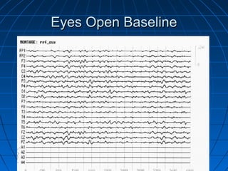 Eyes Open BaselineEyes Open Baseline
 