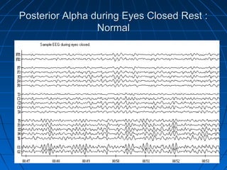 Posterior Alpha during Eyes Closed Rest :Posterior Alpha during Eyes Closed Rest :
NormalNormal
 