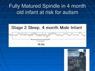 Fully Matured Spindle in 4 monthFully Matured Spindle in 4 month
old infant at risk for autismold infant at risk for autism
 
