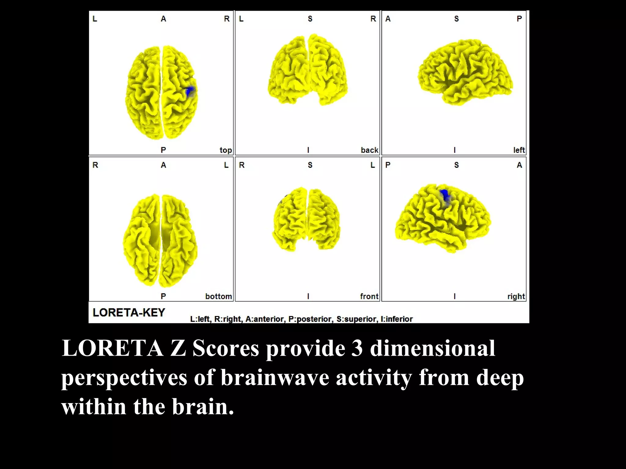 LORETA Z Scores provide 3 dimensional perspectives of brainwave activity from deep within the brain. 