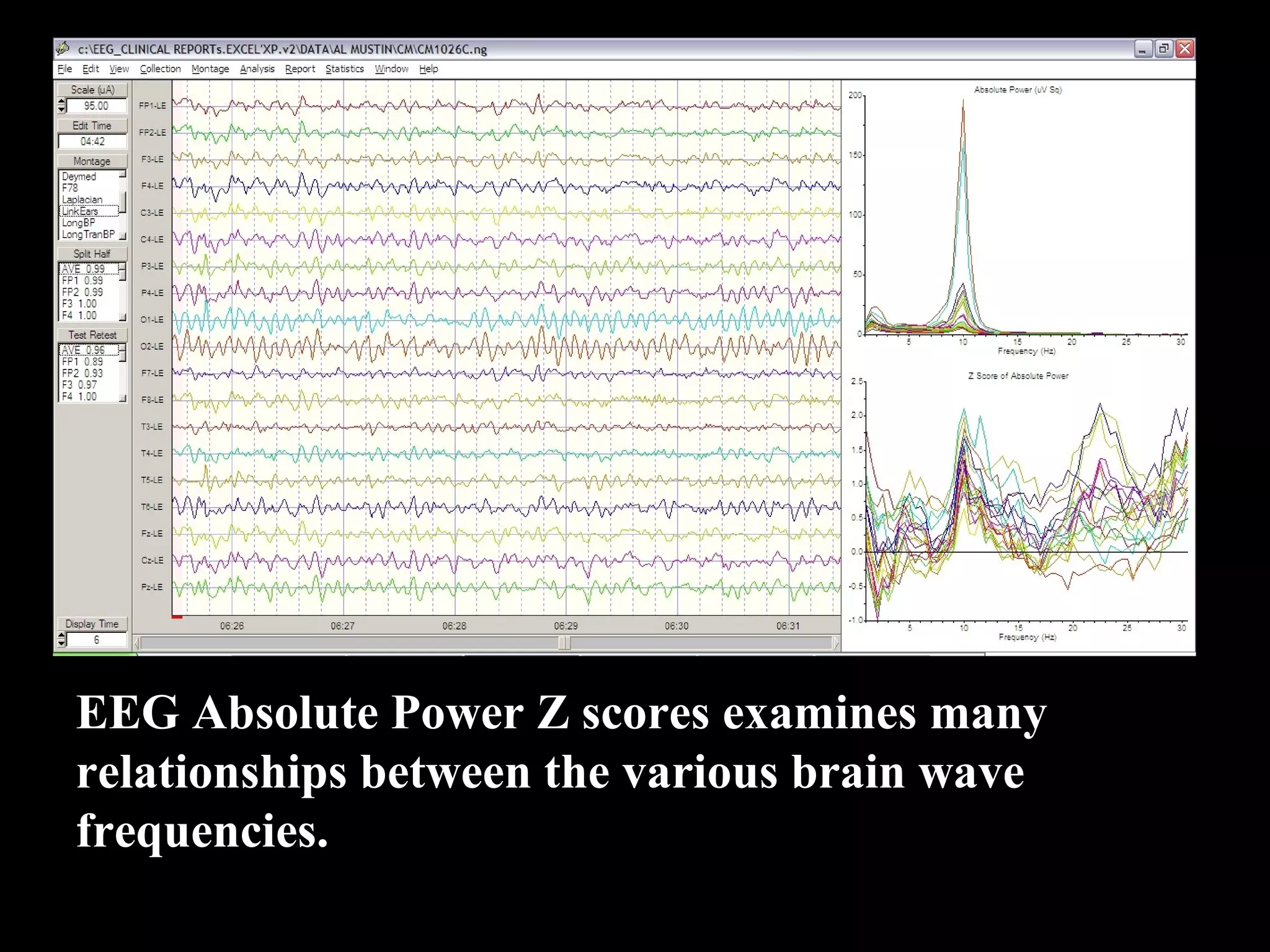 EEG Absolute Power Z scores examines many  relationships between the various brain wave  frequencies.  
