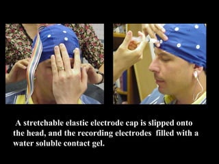  A stretchable elastic electrode cap is slipped onto 
the head, and the recording electrodes  filled with a 
water soluble contact gel. 
 