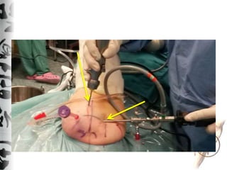Technique of bursectomy