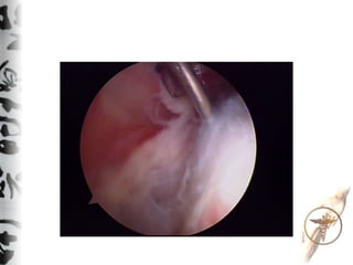 Technique of bursectomy