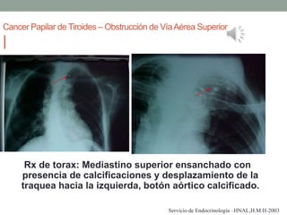 Cancer Papilar de Tiroides – Obstrucción de VíaAérea Superior
|
Rx de torax: Mediastino superior ensanchado con
presencia de calcificaciones y desplazamiento de la
traquea hacia la izquierda, botón aórtico calcificado.
Servicio de Endocrinología –HNAL,H.M.H-2003
 