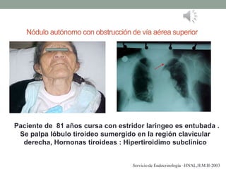 Nódulo autónomo con obstrucción de vía aérea superior
Paciente de 81 años cursa con estridor laringeo es entubada .
Se palpa lóbulo tiroideo sumergido en la región clavicular
derecha, Hornonas tiroideas : Hipertiroidimo subclínico
Servicio de Endocrinología –HNAL,H.M.H-2003
 