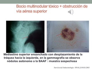 Bocio multinodular tóxico + obstrucción de
vía aérea superior
Mediastino superior ensanchado con desplazamiento de la
tráquea hacia la izquierda, en la gammagrafía se observa
nódulos autónomo a la BAAF : muestra sospechosa
Servicio de Endocrinología –HNAL,H.M.H-2003
 