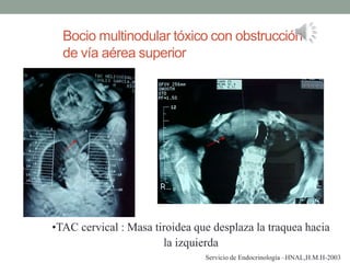 Bocio multinodular tóxico con obstrucción
de vía aérea superior
Servicio de Endocrinología –HNAL,H.M.H-2003
•TAC cervical : Masa tiroidea que desplaza la traquea hacia
la izquierda
 