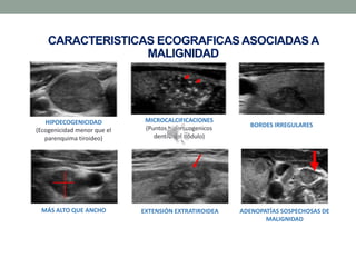 CARACTERISTICAS ECOGRAFICASASOCIADAS A
MALIGNIDAD
HIPOECOGENICIDAD
(Ecogenicidad menor que el
parenquima tiroideo)
MICROCALCIFICACIONES
(Puntos hiperecogenicos
dentro del nódulo)
BORDES IRREGULARES
MÁS ALTO QUE ANCHO EXTENSIÓN EXTRATIROIDEA ADENOPATÍAS SOSPECHOSAS DE
MALIGNIDAD
 