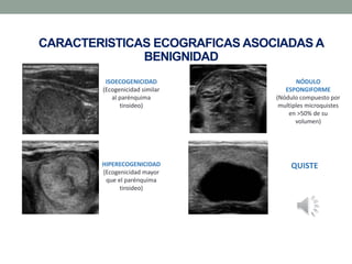 CARACTERISTICAS ECOGRAFICAS ASOCIADAS A
BENIGNIDAD
ISOECOGENICIDAD
(Ecogenicidad similar
al parénquima
tiroideo)
NÓDULO
ESPONGIFORME
(Nódulo compuesto por
multiples microquistes
en >50% de su
volumen)
HIPERECOGENICIDAD
(Ecogenicidad mayor
que el parénquima
tiroideo)
QUISTE
 