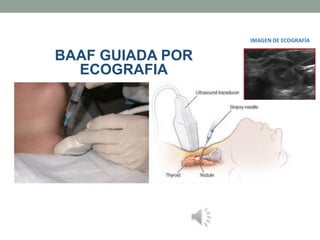 BAAF GUIADA POR
ECOGRAFIA
IMAGEN DE ECOGRAFÍA
 