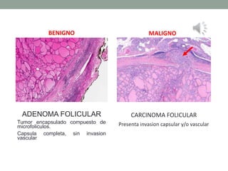 ADENOMA FOLICULAR
Tumor encapsulado compuesto de
microfoliculos.
Capsula completa, sin invasion
vascular
CARCINOMA FOLICULAR
Presenta invasion capsular y/o vascular
BENIGNO MALIGNO
 