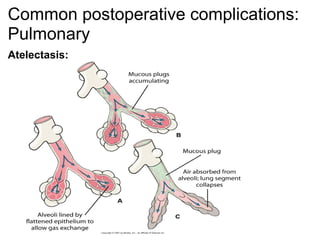 Common postoperative complications:
Pulmonary
Atelectasis:
 