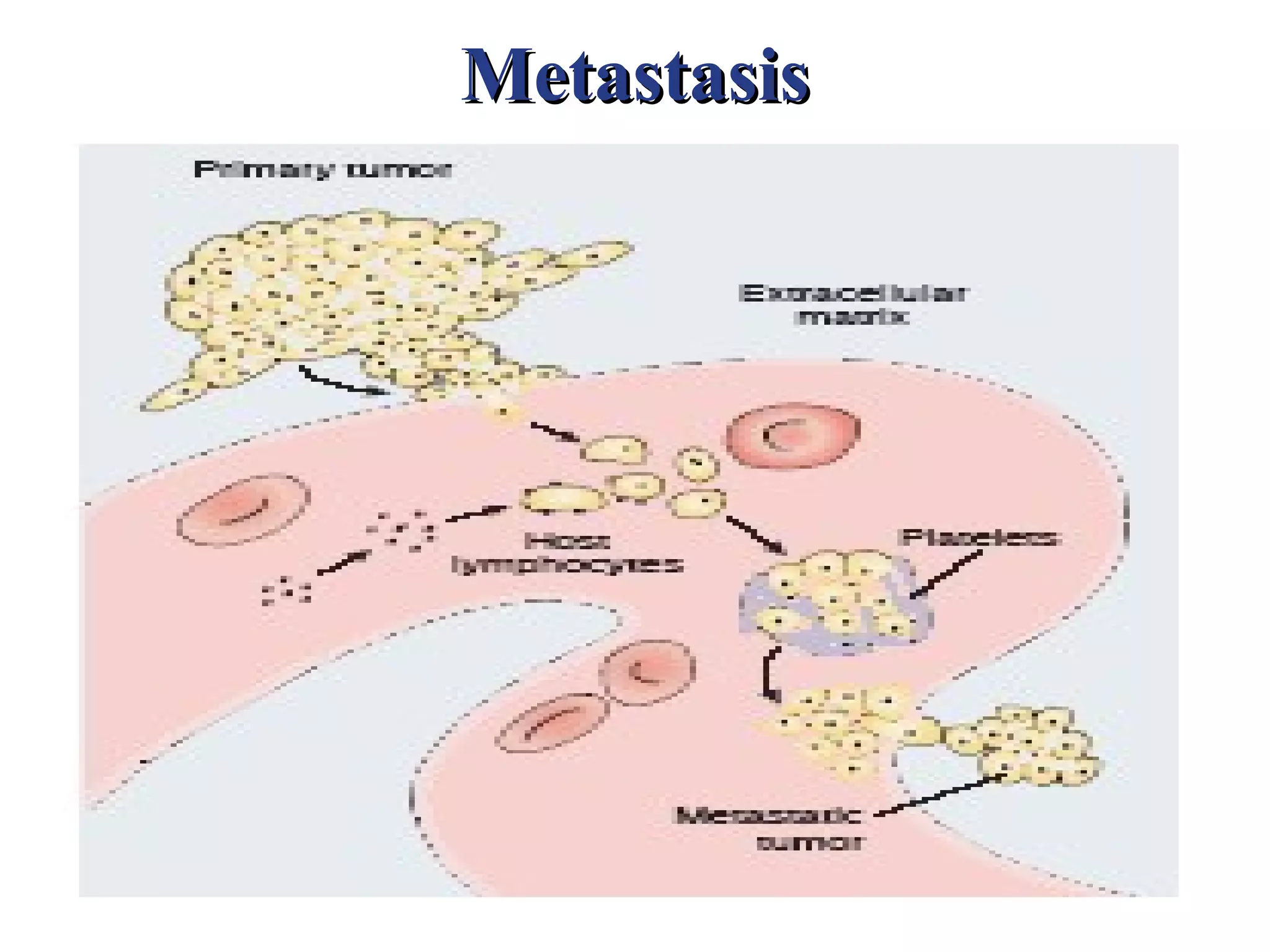 Metastasis
 