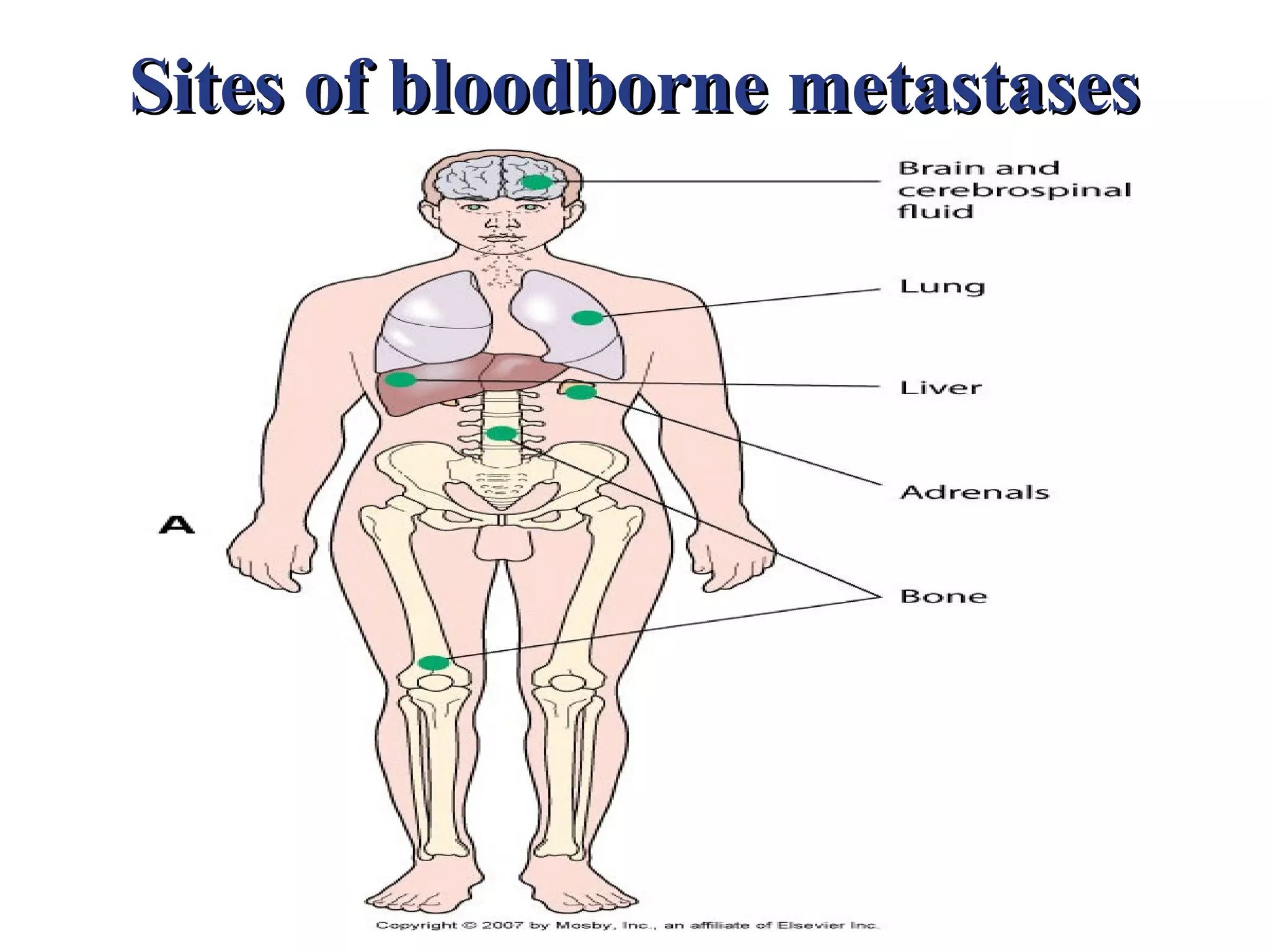 Sites of bloodborne metastases
 