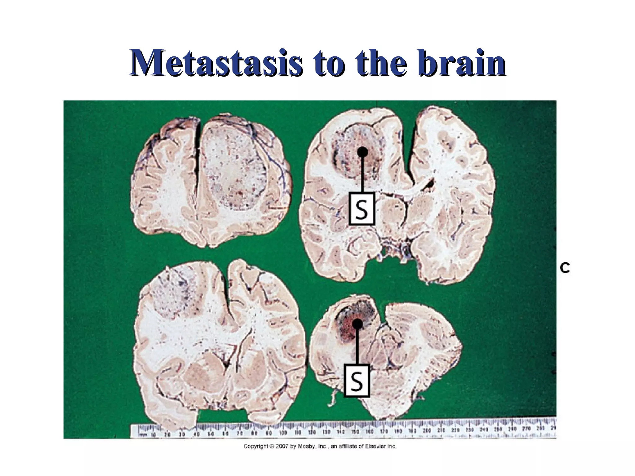 Metastasis to the brain
 