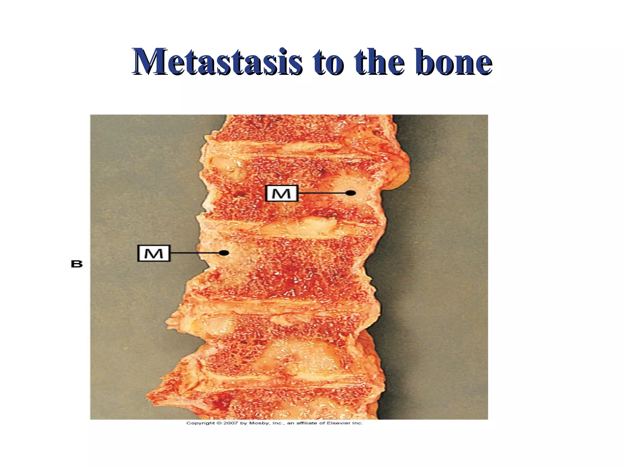 Metastasis to the bone
 