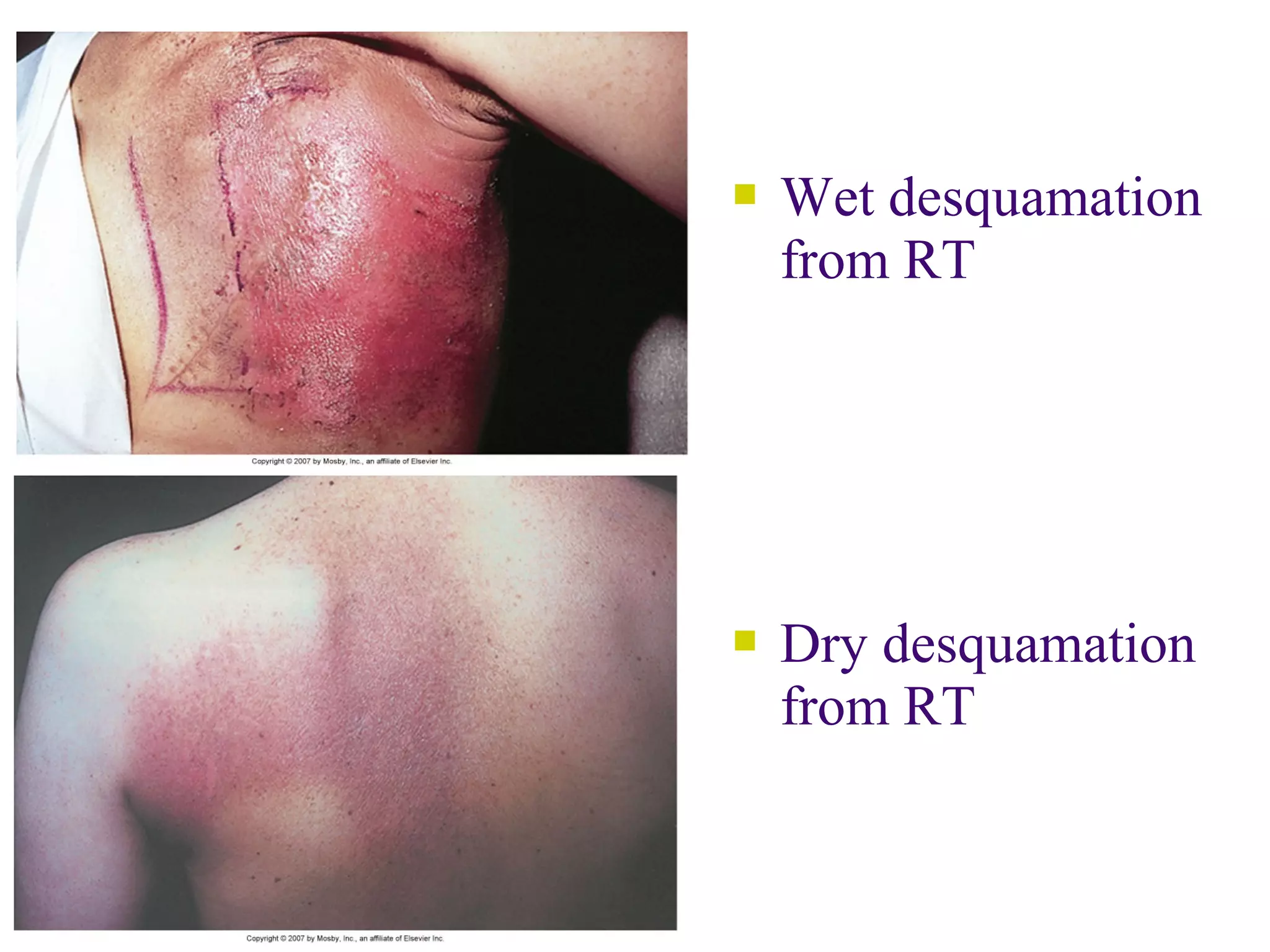    Wet desquamation
    from RT




   Dry desquamation
    from RT
 