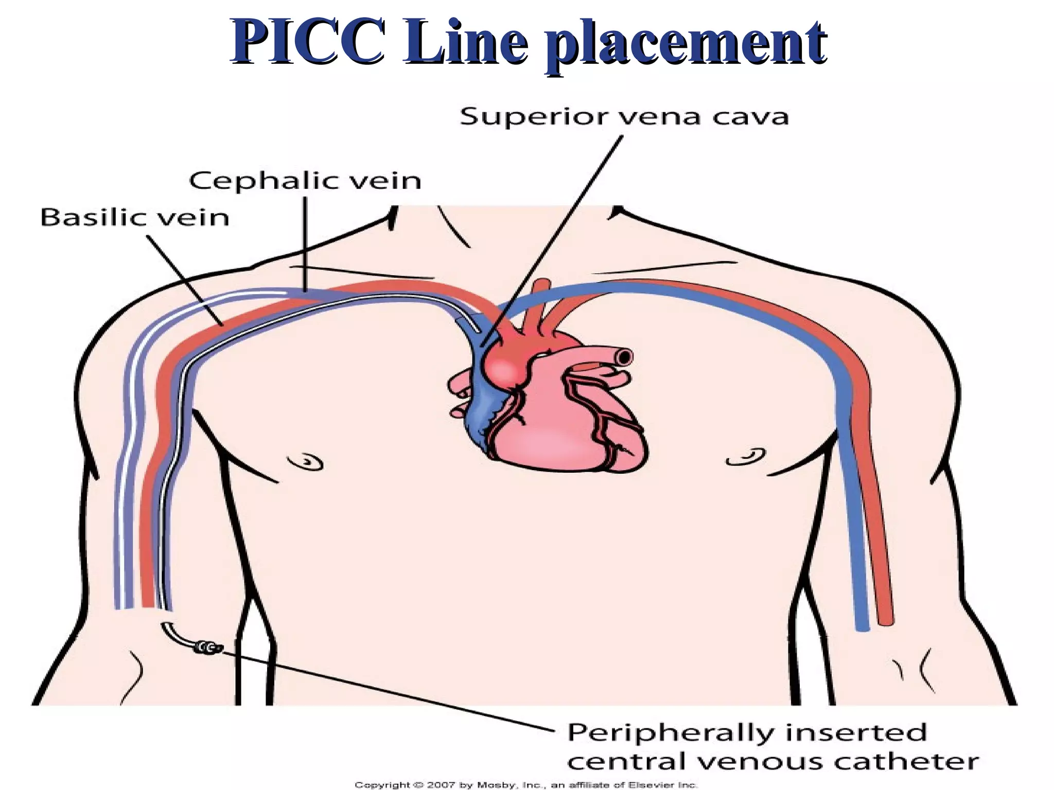 PICC Line placement
 