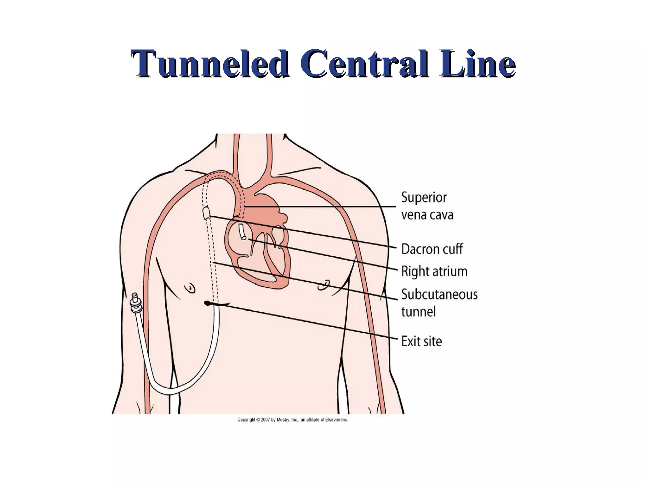 Tunneled Central Line
 