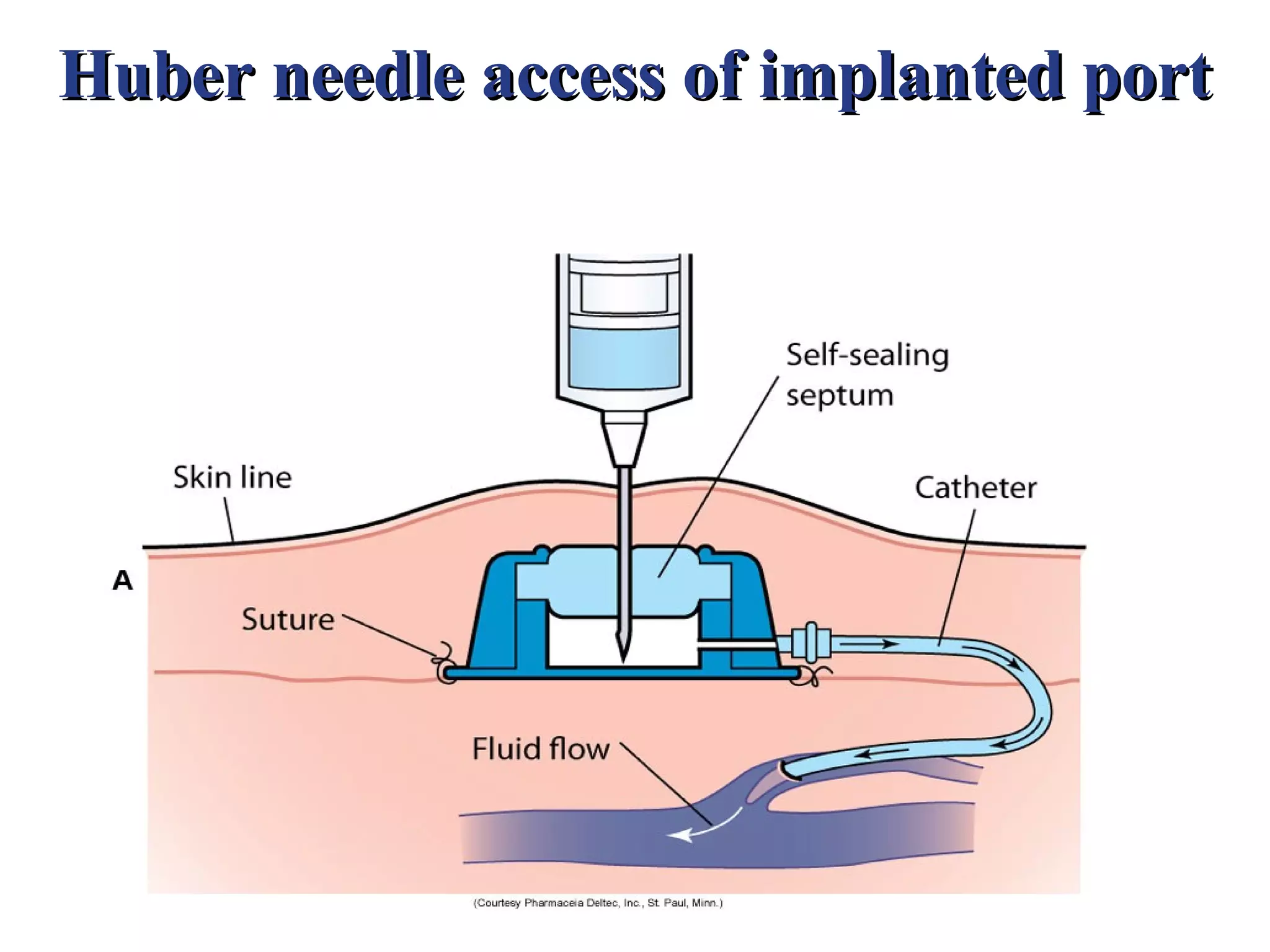 Huber needle access of implanted port
 