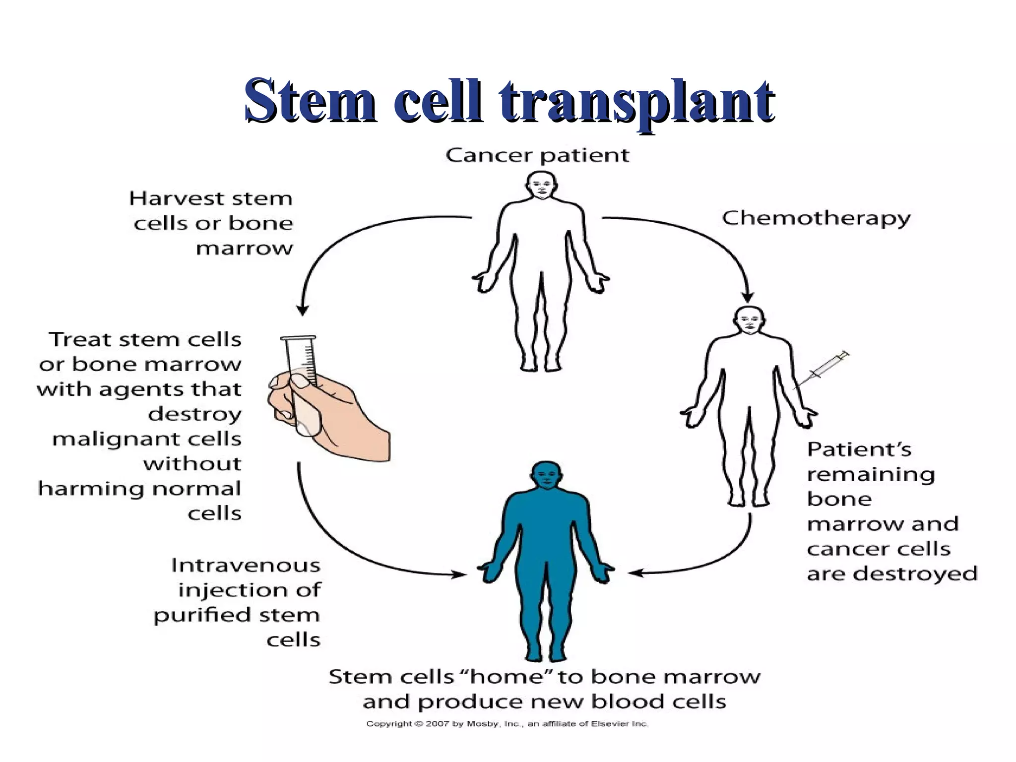 Stem cell transplant
 