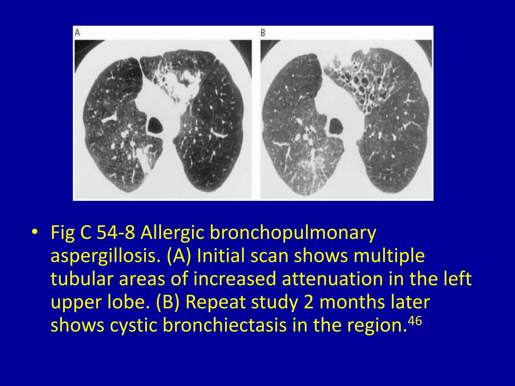 • Fig C 54-8 Allergic bronchopulmonary
aspergillosis. (A) Initial scan shows multiple
tubular areas of increased attenuation in the left
upper lobe. (B) Repeat study 2 months later
shows cystic bronchiectasis in the region.46