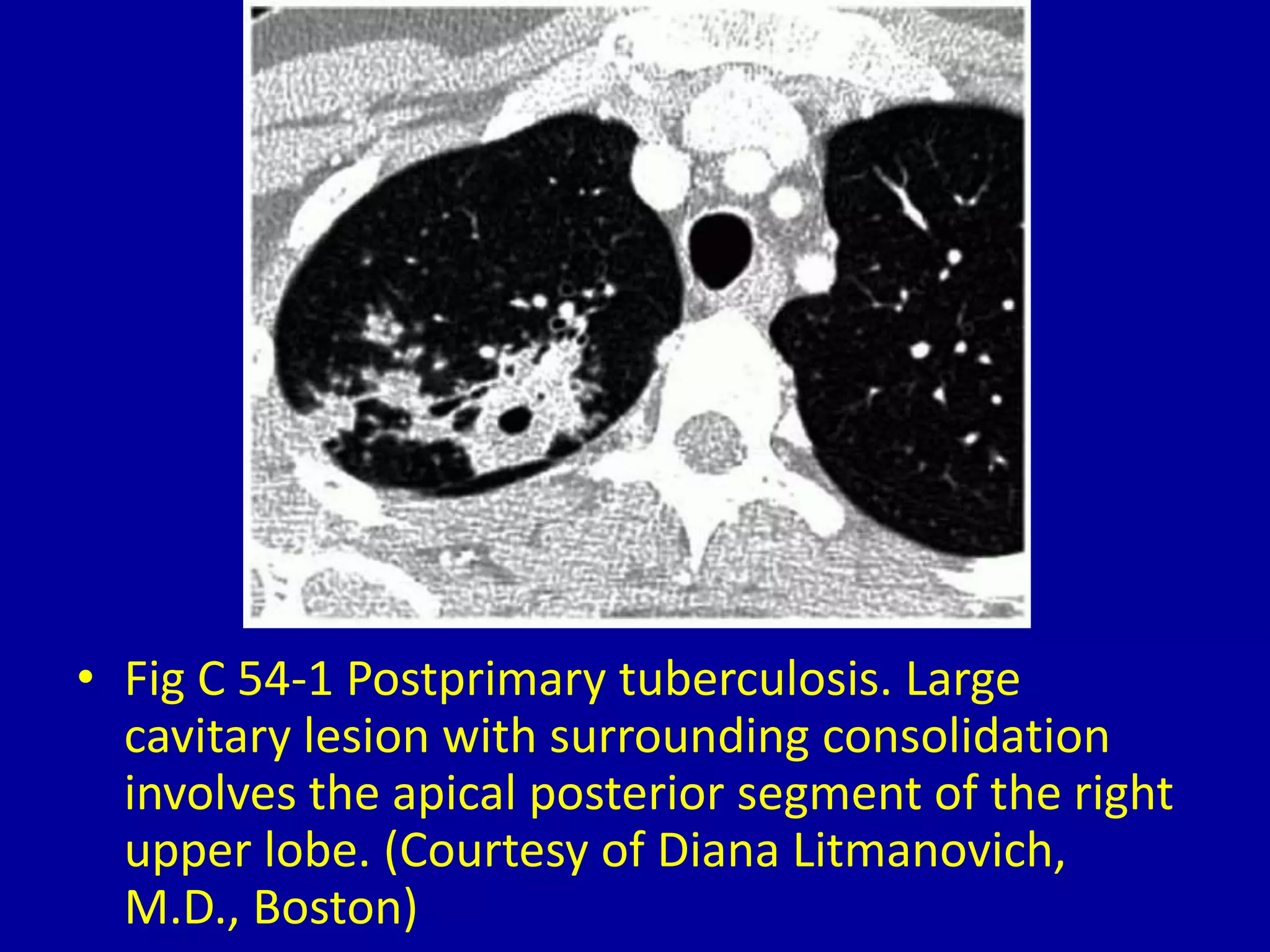 • Fig C 54-1 Postprimary tuberculosis. Large
cavitary lesion with surrounding consolidation
involves the apical posterior segment of the right
upper lobe. (Courtesy of Diana Litmanovich,
M.D., Boston)
