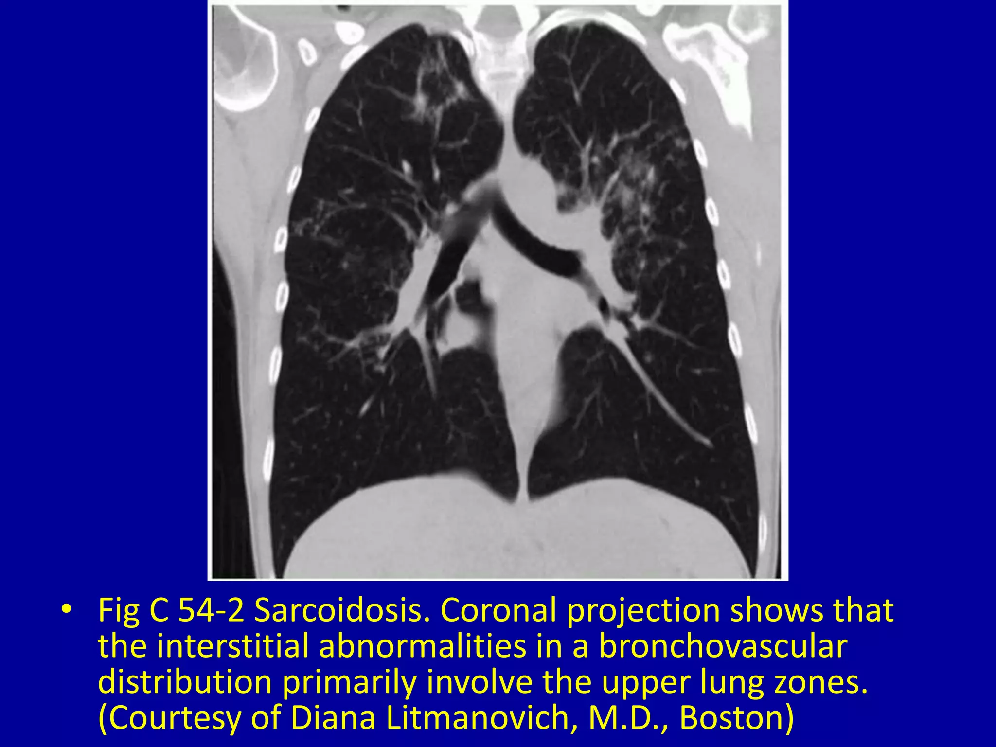 • Fig C 54-2 Sarcoidosis. Coronal projection shows that
the interstitial abnormalities in a bronchovascular
distribution primarily involve the upper lung zones.
(Courtesy of Diana Litmanovich, M.D., Boston)