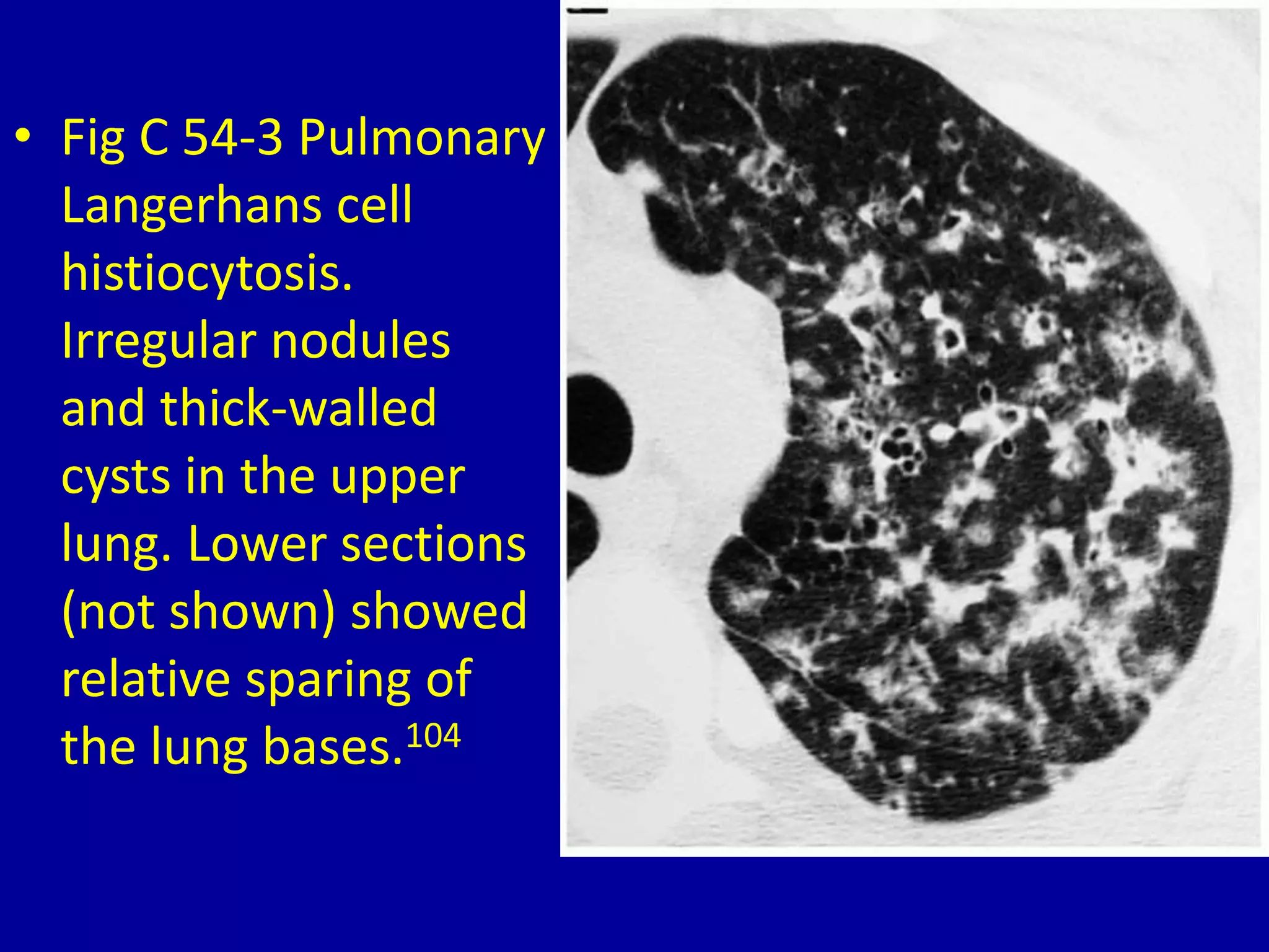 • Fig C 54-3 Pulmonary
Langerhans cell
histiocytosis.
Irregular nodules
and thick-walled
cysts in the upper
lung. Lower sections
(not shown) showed
relative sparing of
the lung bases.104