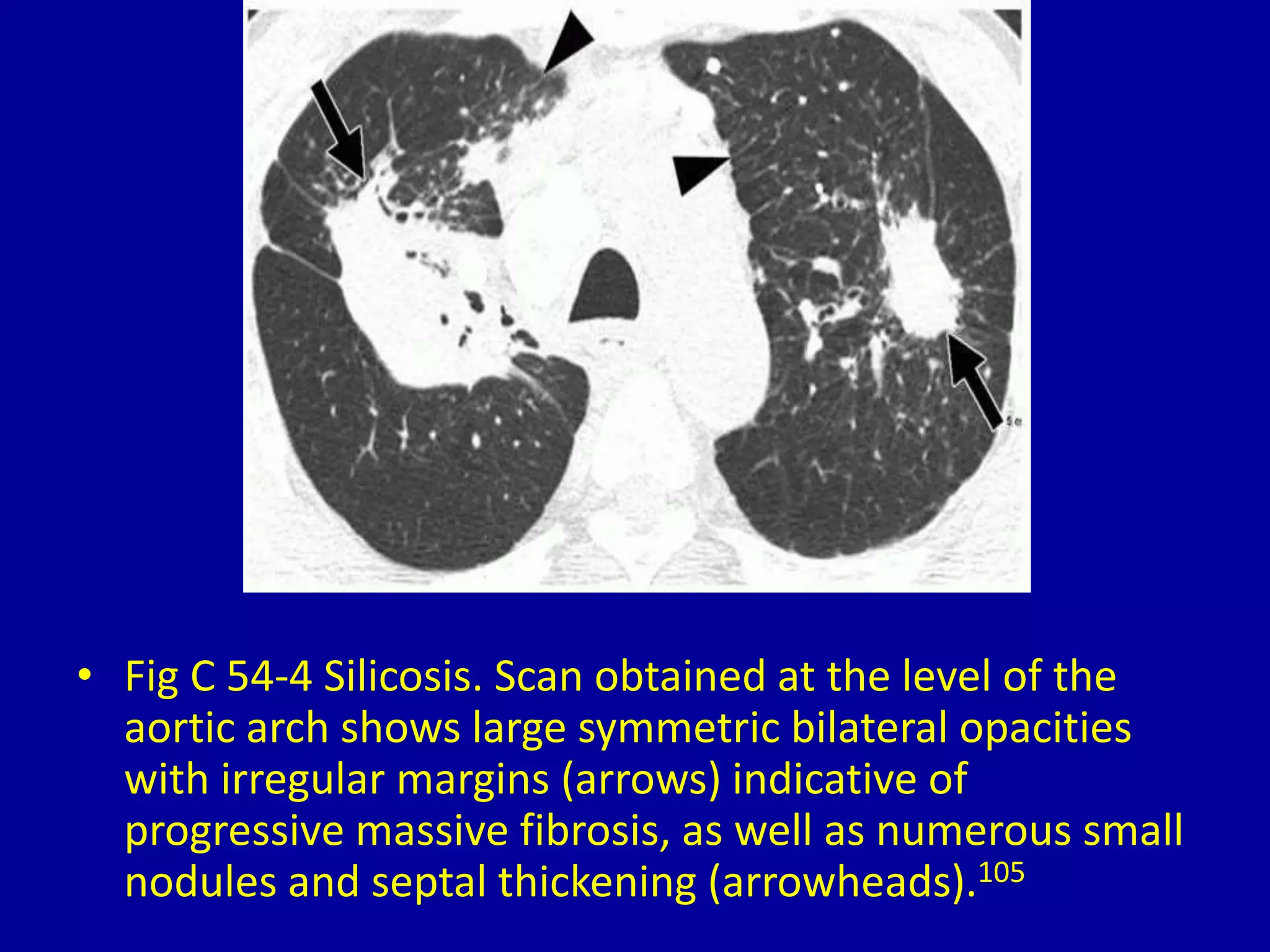 • Fig C 54-4 Silicosis. Scan obtained at the level of the
aortic arch shows large symmetric bilateral opacities
with irregular margins (arrows) indicative of
progressive massive fibrosis, as well as numerous small
nodules and septal thickening (arrowheads).105