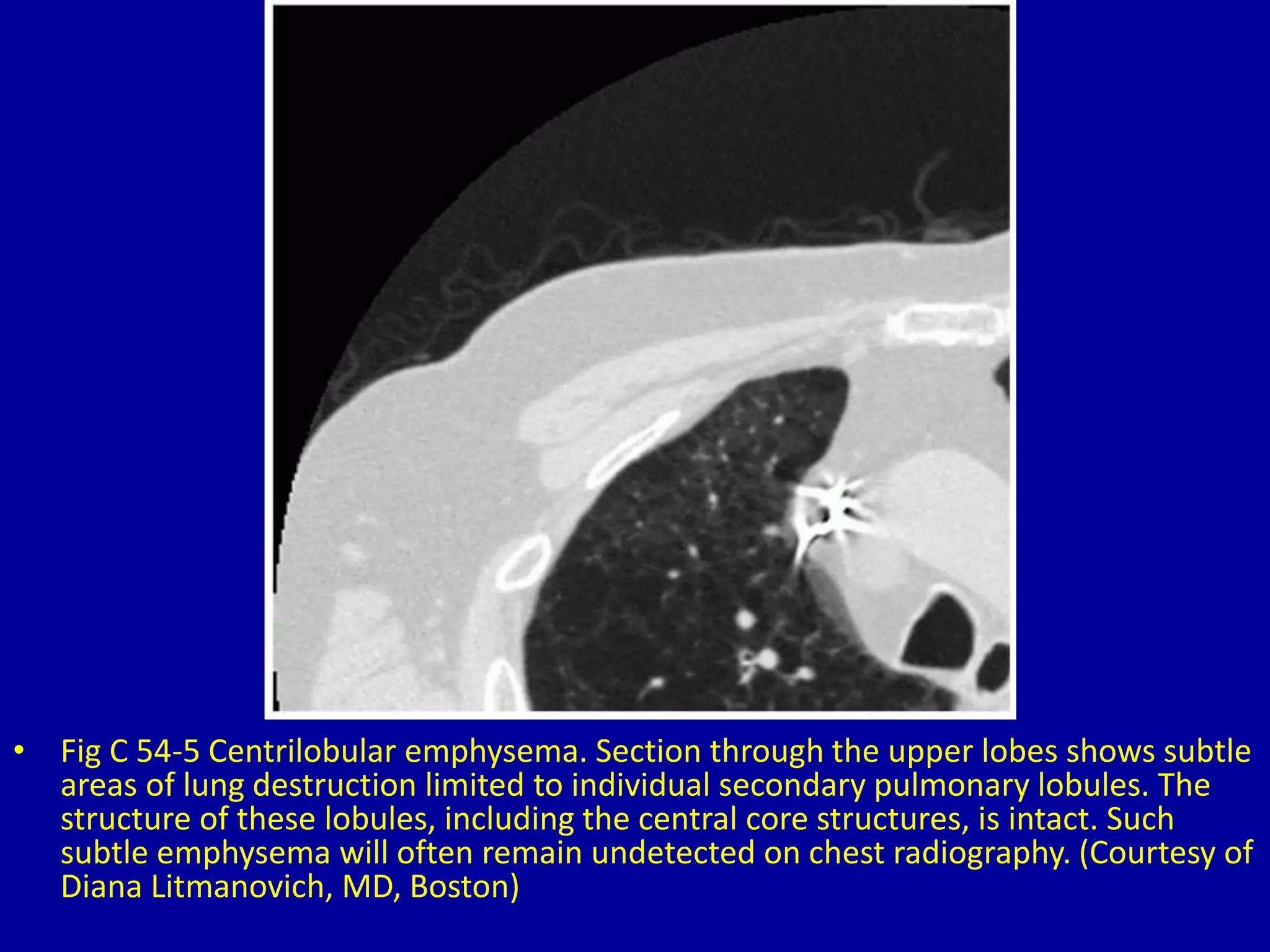 • Fig C 54-5 Centrilobular emphysema. Section through the upper lobes shows subtle
areas of lung destruction limited to individual secondary pulmonary lobules. The
structure of these lobules, including the central core structures, is intact. Such
subtle emphysema will often remain undetected on chest radiography. (Courtesy of
Diana Litmanovich, MD, Boston)