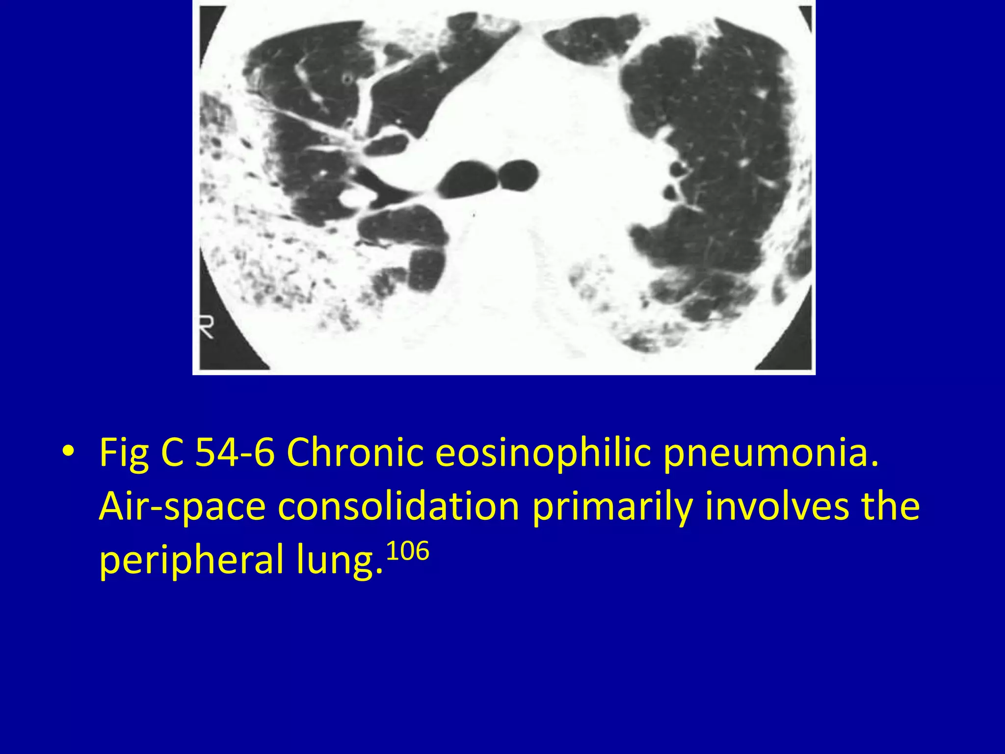 • Fig C 54-6 Chronic eosinophilic pneumonia.
Air-space consolidation primarily involves the
peripheral lung.106