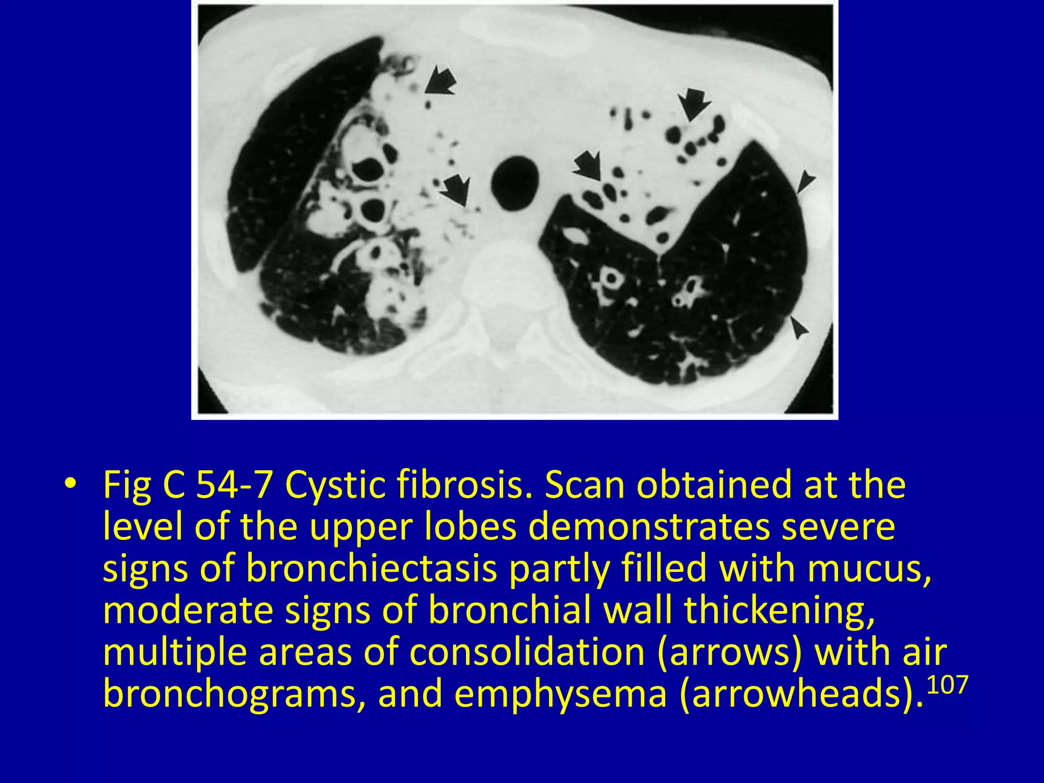 • Fig C 54-7 Cystic fibrosis. Scan obtained at the
level of the upper lobes demonstrates severe
signs of bronchiectasis partly filled with mucus,
moderate signs of bronchial wall thickening,
multiple areas of consolidation (arrows) with air
bronchograms, and emphysema (arrowheads).107