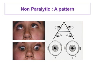 55. INCOMITANT STRABISMUS PRESENTATION BY RAHUL.pptx