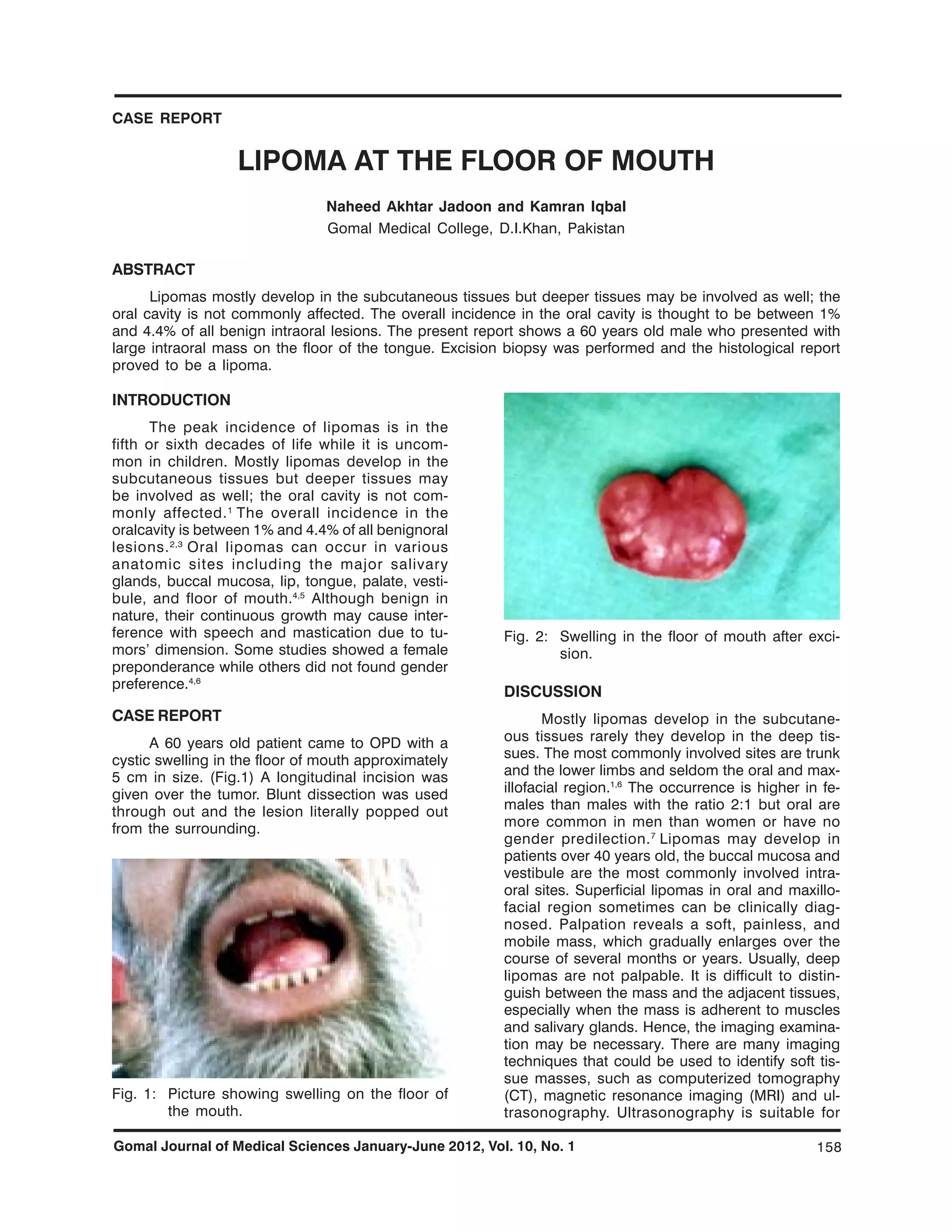 lipoma at floor of mouth | PDF