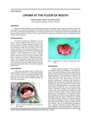 CASE REPORT


                   LIPOMA AT THE FLOOR OF MOUTH
                                Naheed Akhtar Jadoon and Kamran Iqbal
                                Gomal Medical College, D.I.Khan, Pakistan

ABSTRACT
      Lipomas mostly develop in the subcutaneous tissues but deeper tissues may be involved as well; the
oral cavity is not commonly affected. The overall incidence in the oral cavity is thought to be between 1%
and 4.4% of all benign intraoral lesions. The present report shows a 60 years old male who presented with
large intraoral mass on the floor of the tongue. Excision biopsy was performed and the histological report
proved to be a lipoma.

INTRODUCTION
       The peak incidence of lipomas is in the
fifth or sixth decades of life while it is uncom-
mon in children. Mostly lipomas develop in the
subcutaneous tissues but deeper tissues may
be involved as well; the oral cavity is not com-
monly affected. 1 The overall incidence in the
oralcavity is between 1% and 4.4% of all benignoral
lesions. 2,3 Oral lipomas can occur in various
anatomic sites including the major salivary
glands, buccal mucosa, lip, tongue, palate, vesti-
bule, and floor of mouth.4,5 Although benign in
nature, their continuous growth may cause inter-
ference with speech and mastication due to tu-           Fig. 2: Swelling in the floor of mouth after exci-
mors’ dimension. Some studies showed a female                    sion.
preponderance while others did not found gender
preference.4,6
                                                         DISCUSSION
CASE REPORT                                                     Mostly lipomas develop in the subcutane-
      A 60 years old patient came to OPD with a          ous tissues rarely they develop in the deep tis-
cystic swelling in the floor of mouth approximately      sues. The most commonly involved sites are trunk
5 cm in size. (Fig.1) A longitudinal incision was        and the lower limbs and seldom the oral and max-
given over the tumor. Blunt dissection was used          illofacial region.1,6 The occurrence is higher in fe-
through out and the lesion literally popped out          males than males with the ratio 2:1 but oral are
from the surrounding.                                    more common in men than women or have no
                                                         gender predilection. 7 Lipomas may develop in
                                                         patients over 40 years old, the buccal mucosa and
                                                         vestibule are the most commonly involved intra-
                                                         oral sites. Superficial lipomas in oral and maxillo-
                                                         facial region sometimes can be clinically diag-
                                                         nosed. Palpation reveals a soft, painless, and
                                                         mobile mass, which gradually enlarges over the
                                                         course of several months or years. Usually, deep
                                                         lipomas are not palpable. It is difficult to distin-
                                                         guish between the mass and the adjacent tissues,
                                                         especially when the mass is adherent to muscles
                                                         and salivary glands. Hence, the imaging examina-
                                                         tion may be necessary. There are many imaging
                                                         techniques that could be used to identify soft tis-
                                                         sue masses, such as computerized tomography
Fig. 1: Picture showing swelling on the floor of         (CT), magnetic resonance imaging (MRI) and ul-
        the mouth.                                       trasonography. Ultrasonography is suitable for

Gomal Journal of Medical Sciences January-June 2012, Vol. 10, No. 1                                       158
 