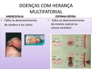 DOENÇAS COM HERANÇA
MULTIFATORIAL
ANENCEFALIA
• Falha no desenvolvimento
do cérebro e do crânio
ESPINHA BÍFIDA
• Falha no desenvolvimento
da medula espinal ou
coluna vertebral
 