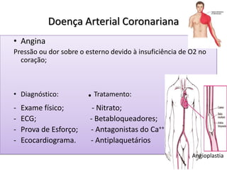 Doença Arterial Coronariana
• Angina
Pressão ou dor sobre o esterno devido à insuficiência de O2 no
coração;
• Diagnóstico: .Tratamento:
- Exame físico; - Nitrato;
- ECG; - Betabloqueadores;
- Prova de Esforço; - Antagonistas do Ca++
- Ecocardiograma. - Antiplaquetários
Angioplastia
 