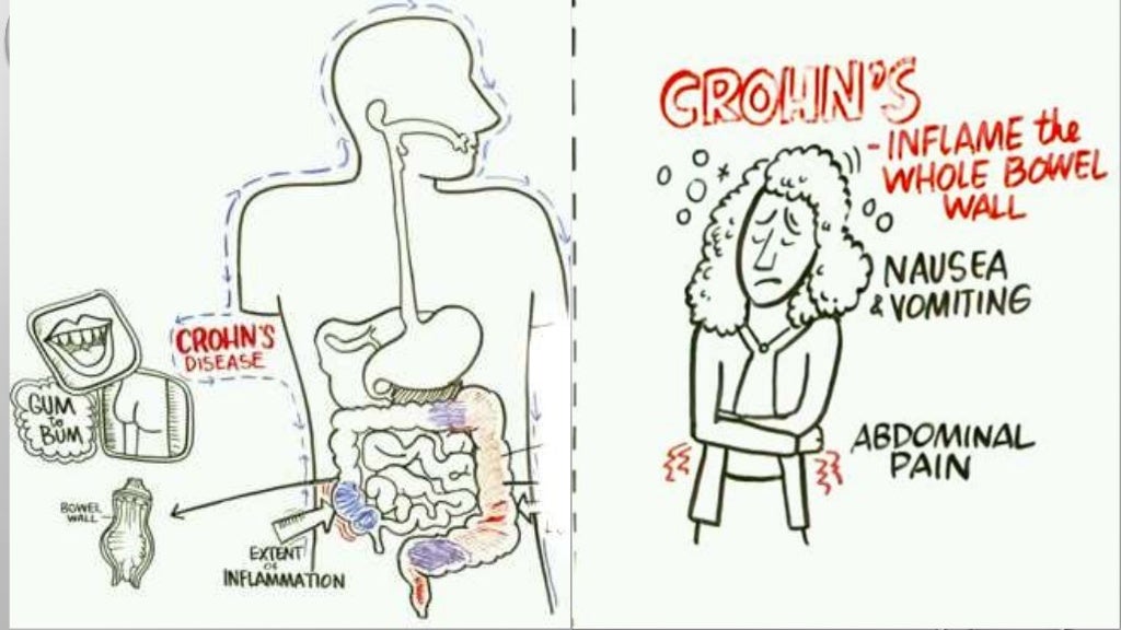 INFLAMMATORY BOWEL DISEASE ppt