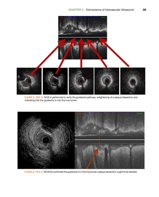 Ivus Disection Intravascular Ultrasound From Acquisition To Advanced Quantitative ...