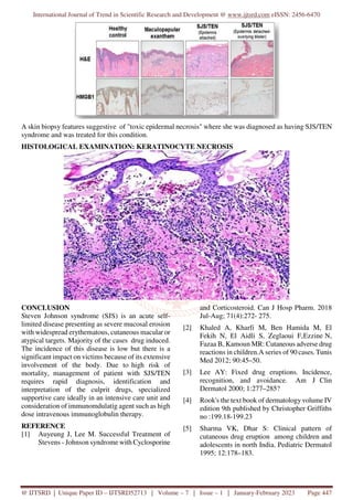 International Journal of Trend in Scientific Research and Development @ www.ijtsrd.com eISSN: 2456-6470
@ IJTSRD | Unique Paper ID – IJTSRD52713 | Volume – 7 | Issue – 1 | January-February 2023 Page 447
A skin biopsy features suggestive of "toxic epidermal necrosis" where she was diagnosed as having SJS/TEN
syndrome and was treated for this condition.
HISTOLOGICAL EXAMINATION: KERATINOCYTE NECROSIS
CONCLUSION
Steven Johnson syndrome (SJS) is an acute self-
limited disease presenting as severe mucosal erosion
with widespread erythematous, cutaneous macular or
atypical targets. Majority of the cases drug induced.
The incidence of this disease is low but there is a
significant impact on victims because of its extensive
involvement of the body. Due to high risk of
mortality, management of patient with SJS/TEN
requires rapid diagnosis, identification and
interpretation of the culprit drugs, specialized
supportive care ideally in an intensive care unit and
consideration of immunomdulatig agent such as high
dose intravenous immunoglobulin therapy.
REFERENCE
[1] Auyeung J, Lee M. Successful Treatment of
Stevens - Johnson syndrome with Cyclosporine
and Corticosteroid. Can J Hosp Pharm. 2018
Jul-Aug; 71(4):272- 275.
[2] Khaled A, Kharfi M, Ben Hamida M, El
Fekih N, El Aidli S, Zeglaoui F,Ezzine N,
Fazaa B, Kamoun MR: Cutaneous adverse drug
reactions in children.A series of 90 cases. Tunis
Med 2012; 90:45–50.
[3] Lee AY: Fixed drug eruptions. Incidence,
recognition, and avoidance. Am J Clin
Dermatol 2000; 1:277–285?
[4] Rook's the text book of dermatology volume IV
edition 9th published by Christopher Griffiths
no :199.18-199.23
[5] Sharma VK, Dhar S: Clinical pattern of
cutaneous drug eruption among children and
adolescents in north India. Pediatric Dermatol
1995; 12:178–183.
 