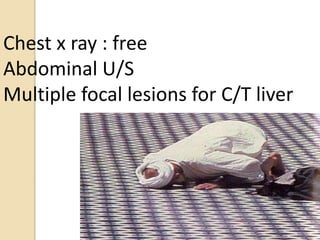 Chest x ray : free
Abdominal U/S
Multiple focal lesions for C/T liver
 