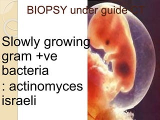 BIOPSY under guide CT
Slowly growing
gram +ve
bacteria
: actinomyces
israeli
 