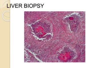LIVER BIOPSY
 