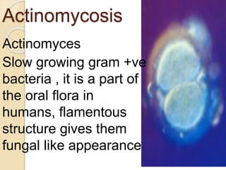 Actinomycosis
Actinomyces
Slow growing gram +ve
bacteria , it is a part of
the oral flora in
humans, flamentous
structure gives them
fungal like appearance
 