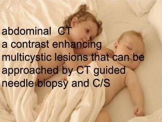 abdominal CT
a contrast enhancing
multicystic lesions that can be
approached by CT guided
needle biopsy and C/S
 